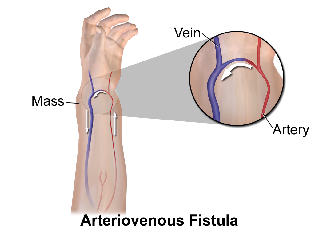 Fistula